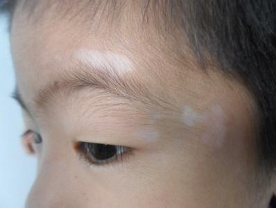 武汉白癜风皮肤病的治疗方法