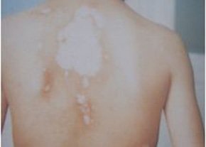 武汉白癜风医院排名?白癜风患者要重视哪些护理?
