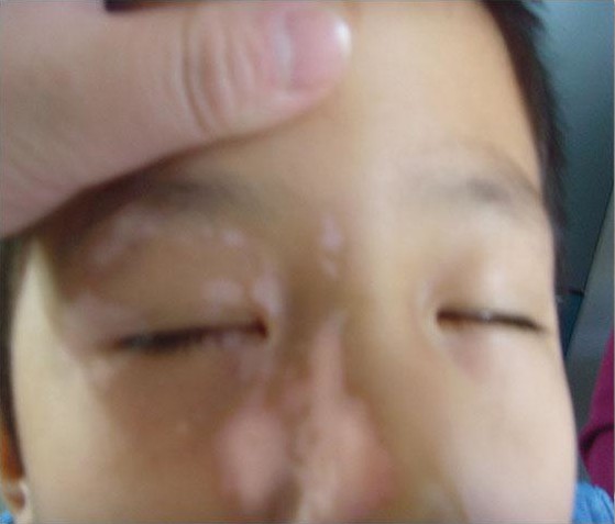 武汉较好的白癜风医院?白癜风患者忌用哪些药物?