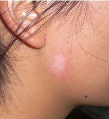 武汉白癜风医院排名?男性夏季该如何预防白癜风扩散?