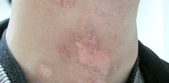 武汉哪里治疗白癜风较好?白癜风怎样自我诊断?
