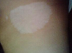 武汉治疗白癜风带多少钱?武汉早期白斑的特点有哪些呢?